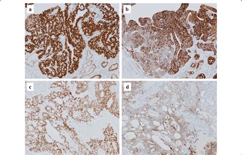 Immunohistochemical Staining Of CDX 2 And CK20 CDX 2 Expression Of The