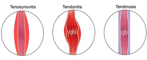 3 Types of Tendinopathies: Tendonitis, Chronic Tendinopathy and Tenosynovitis - Fixio