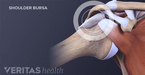 Rotator Cuff Tear Bursitis