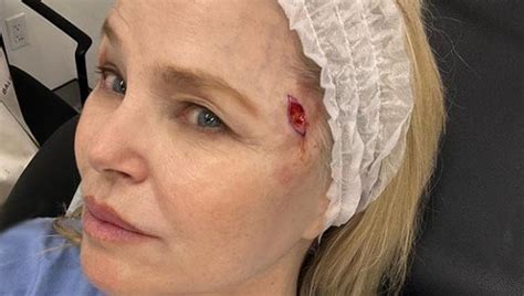 Shock Diagnosis Christie Brinkley With Basal Cell Carcinoma On Her