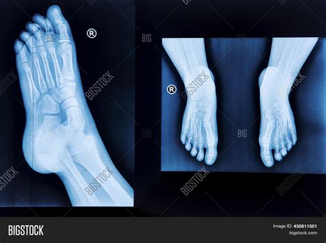 Foot X Ray Normal