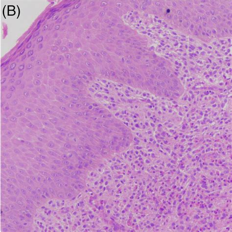 Mastocytoma Over Nape Of The Neck A Single Well‐defined Erythematous