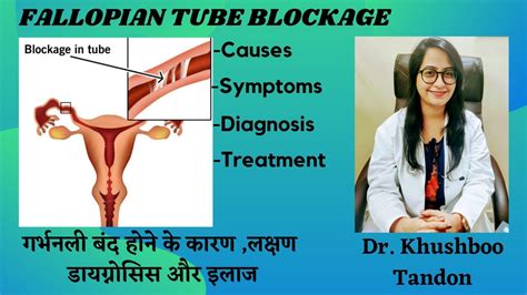 Fallopian Tube Blockage Symptoms Causes And Treatment बंद फैलोपियन ट्यूब के लक्षण कारण और