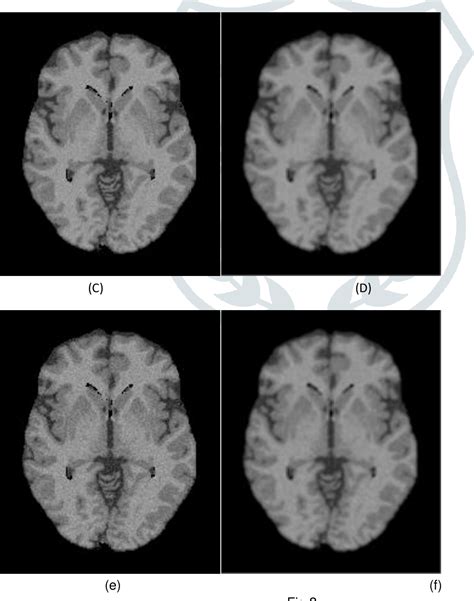 Figure 2 From ANALYSIS OF MRI DENOISING USING FILTERING APPROACH