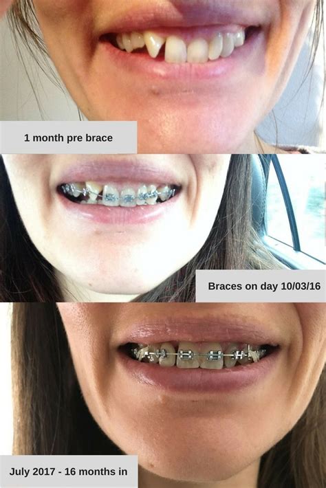 Gap Teeth Before And After Braces