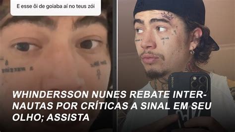 Whindersson Nunes Rebate Internautas Por Cr Ticas A Sinal Em Seu Olho