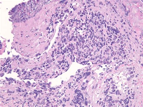 High Power Field × 200 Hematoxylin And Eosin Stain Shows Poorly Download Scientific Diagram