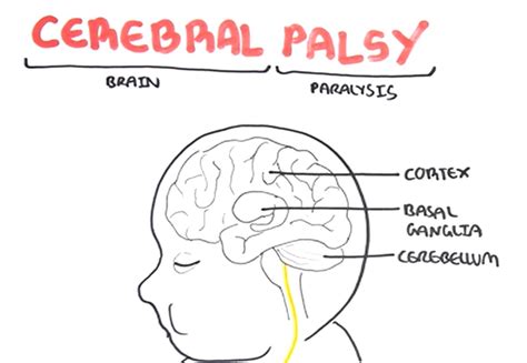 In The Know Understanding The Dynamics Of Cerebral Palsy Series