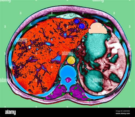 Secondary Liver Cancer Coloured Axial Computed Tomography Ct Scan Showing Multiple Metastases