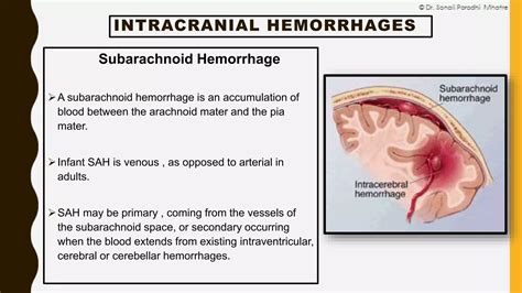 Neonatal Intracranial Hemorrhage By Dr Sonali Mhatre Ppt