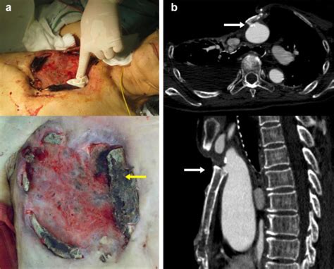 Hybrid Zone Zero Debranching Thoracic Endovascular Aortic Repair Of