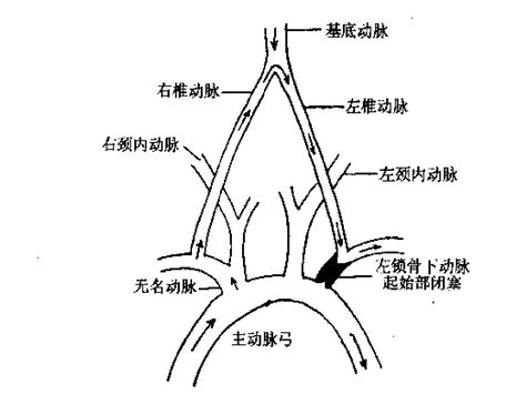 锁骨下动脉盗血综合征word文档在线阅读与下载无忧文档