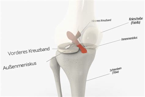 Knie Operation Das Wichtigste Einfach Erkl Rt Knorpelexperte De