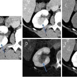 Dual Energy Mixed KV CT Demonstrating A Simple Cyst Blue Arrow With