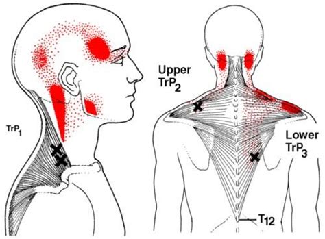 How To Heal From Myofascial Pain Syndrome Usa Sports Therapy