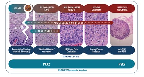 From Precursor Lesion To Hpv Associated Cancer Papivax Biotech Inc