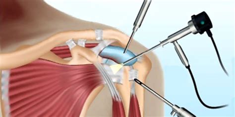 Conoce los tipos de inestabilidad de hombro y los músculos guardianes