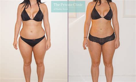 Vaser Liposuction Tpc Front The Private Clinic Of Harley Street