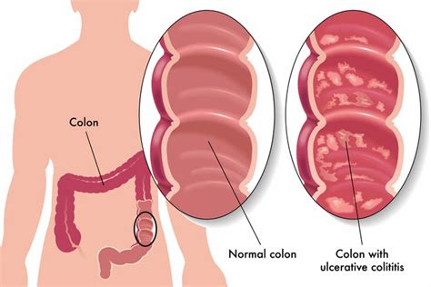 Ulcerative Colitis Treatment In Anand