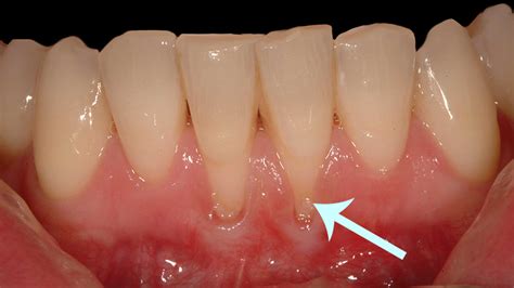 tratamento caseiro e retração gengival Luís Gustavo Leite dentista