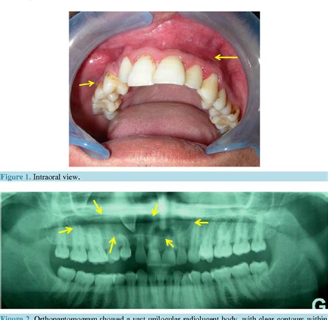 Figure From Odontogenic Keratocyst Tumor A Case Report And