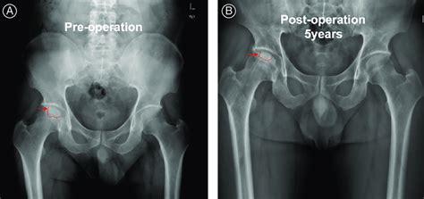 Pelvis X Ray Of Osteonecrosis Of The Right Hip Shows Preserved Joint Download Scientific