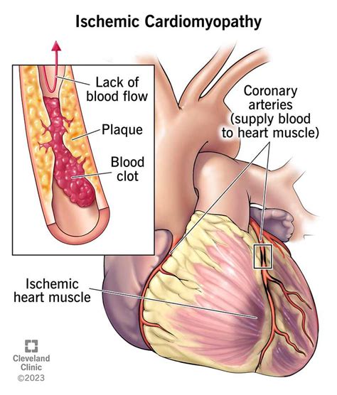 Coronary Artery Disease Symptoms