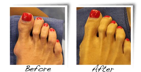 Before After Pictures Feetfixer