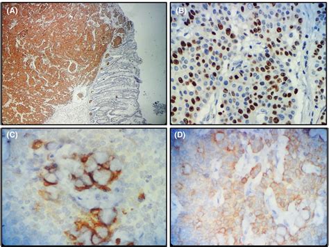 A Immunohistochemistry Demonstrating Strong And Diffuse Staining Of