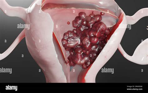 Tumore Maligno Dell Utero Anatomia Femminile Dell Utero Sistema