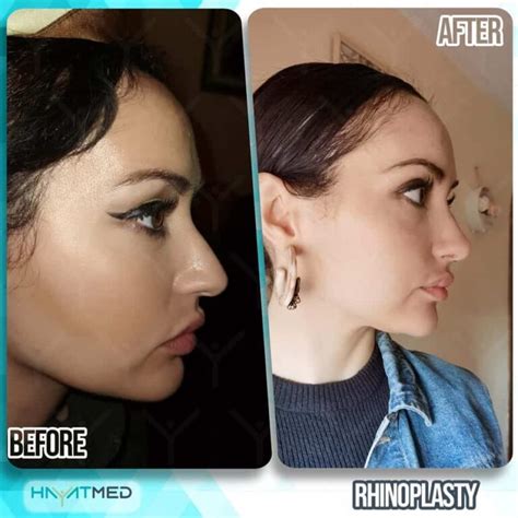 Rhinoplasty Nose Job In Istanbul Turkey With Top Surgeons