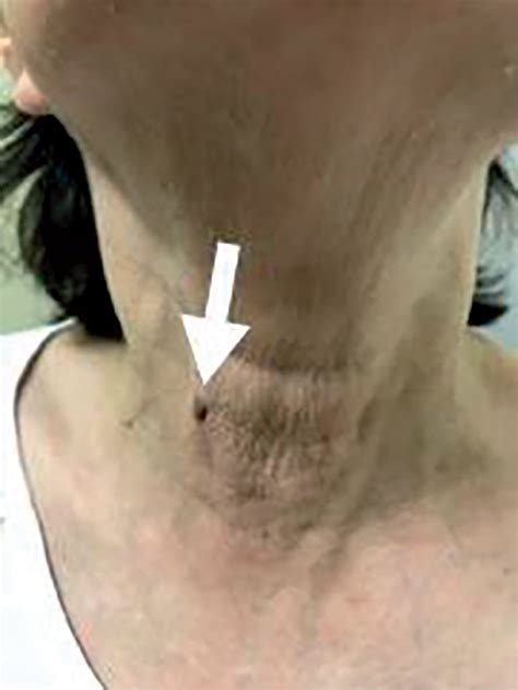 Trans Oral Endoscopic Thyroidectomy Vestibular Approach TOETVA In