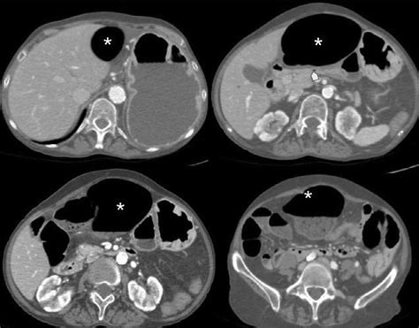 Contrast Enhanced Abdominal Ct Distended Mispositioned Cecum At The Download Scientific