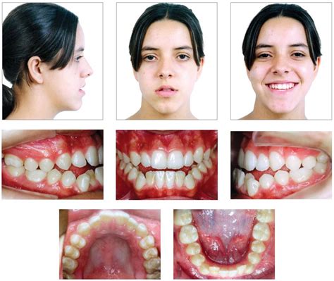 Scielo Brasil Compensatory Class Iii Malocclusion Treatment