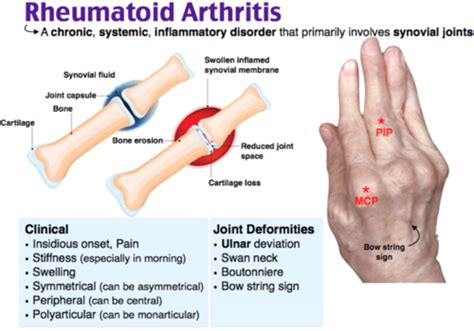 Rheumatoid Arthritis Flashcards Quizlet