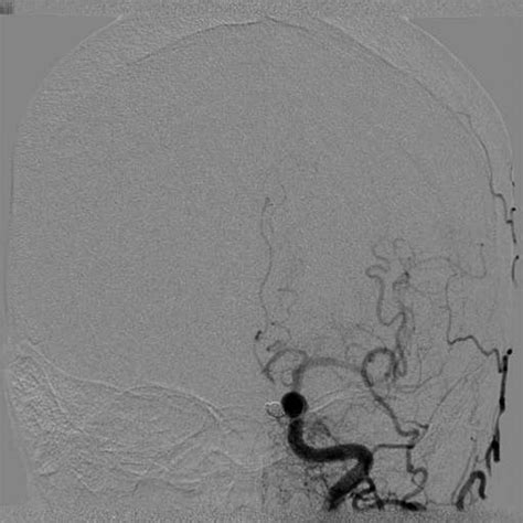 Angiogram Of The Left Common Carotid Artery Immediately After Targeted Download Scientific