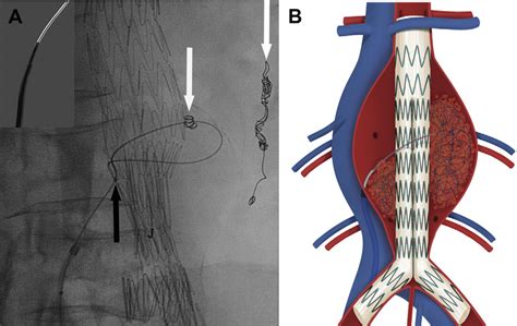 Iliolumbar Artery Endoleak