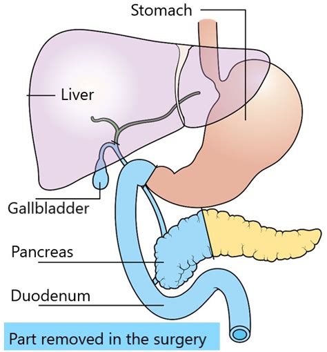 Whipple Procedure Anatomy