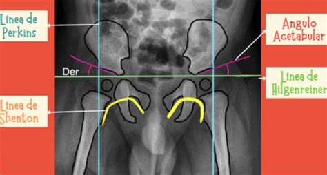 Displasia De Cadera Quizlet