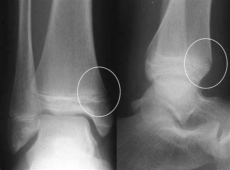 Figure 4 Proximal Tibial Metaphyseal Fracture Explore Pem Flickr