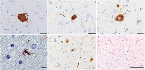 Psp And Comorbid Pathologies A Neurofibrillary Tangle Nft Of Globose