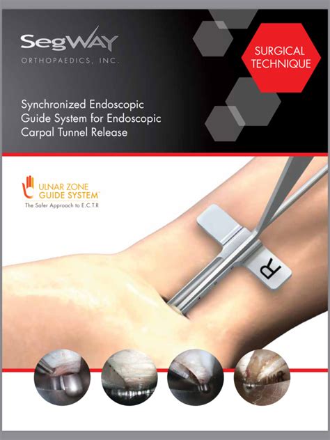 Seg Way Endoscopic Carpal Tunnel Release Ectr Pacific Medical Inc