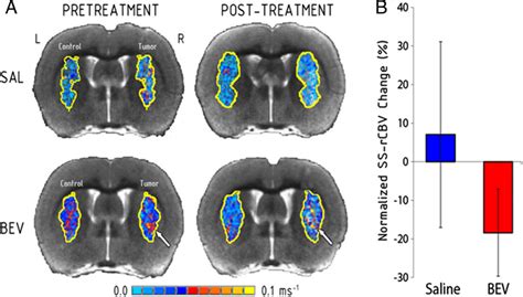 Effect Of Bevacizumab On Tumor Blood Volume Steady State R Maps Of