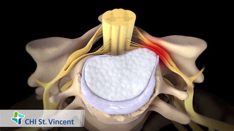 Anterior Cervical Discectomy And Fusion Youtube