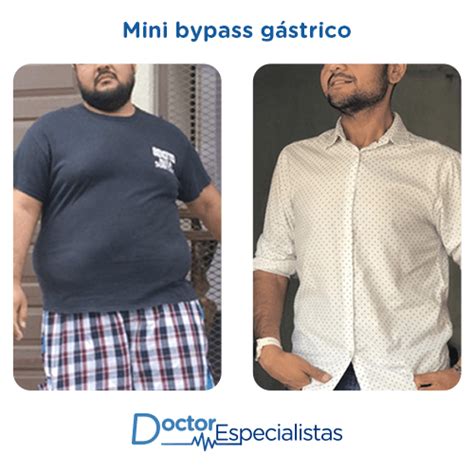 Cirujanos Para Mini Bypass Gastrico Doctor Especialistas