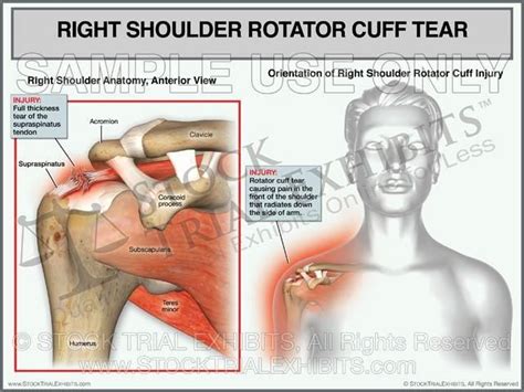 Rotator Cuff Tear Of The Right Shoulder Female Orientation Medium