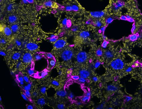 Nkg D Mediated Detection Of Metabolically Stressed Hepatocytes By