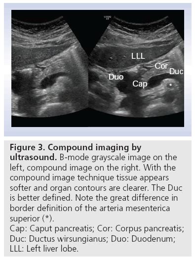 Transabdominal ultrasonography of the pancreas: basic and new aspects