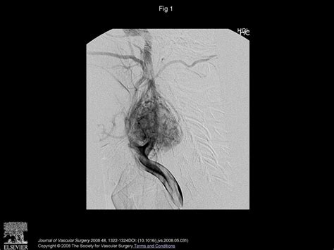 Successful Devascularization Of Carotid Body Tumors By Covered Stent