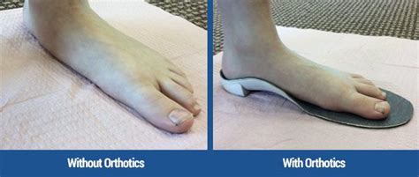 Custom Foot Orthotics Oc Foot And Ankle Clinic Dr Andrew Yang Dpm